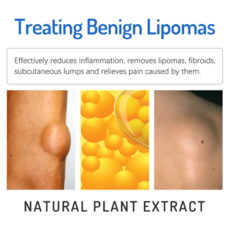 LIPOMA CREAM 20g